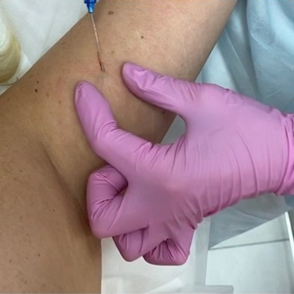 технология HIFU и инъекция Скульптра