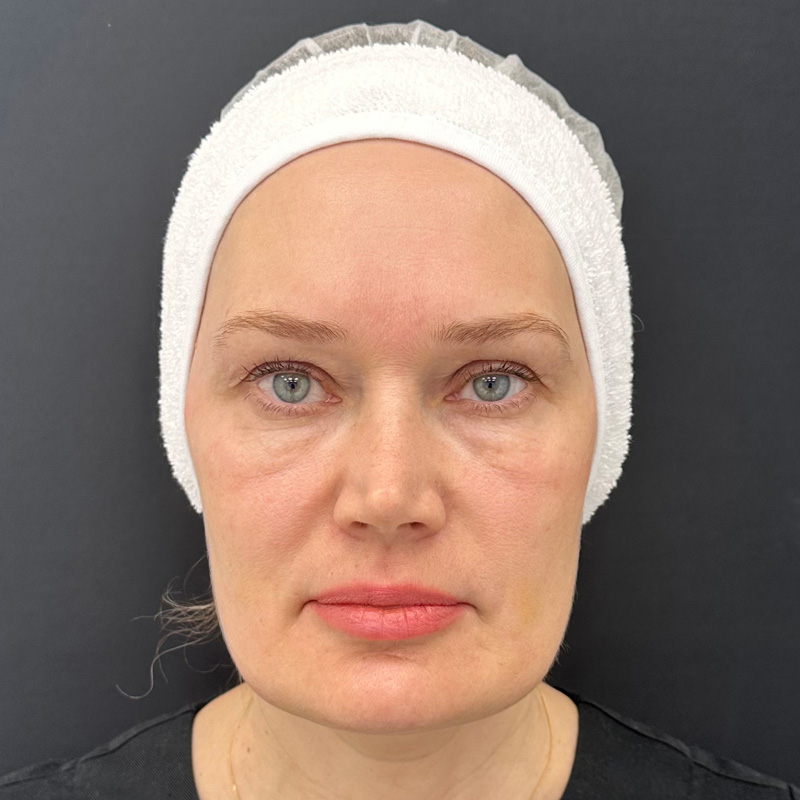 Протокол Bio-Mix Regenyal, фото до