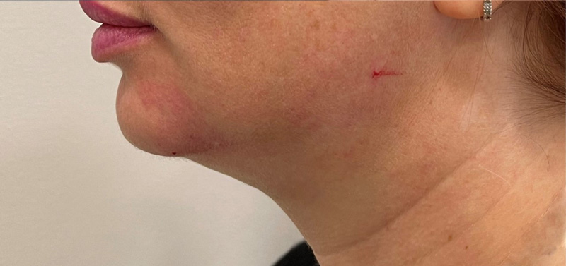 Скульптра плюс криолиполиз