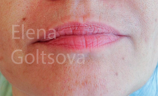 коррекции возрастных губ препаратом Etermis 3, фото до процедуры