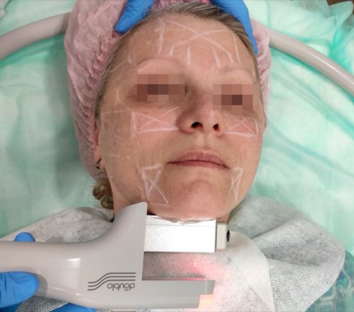 Сканирование субментальной области