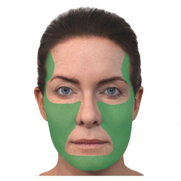 Зоны лица, рекомендованные для использования имплантата Скульптра