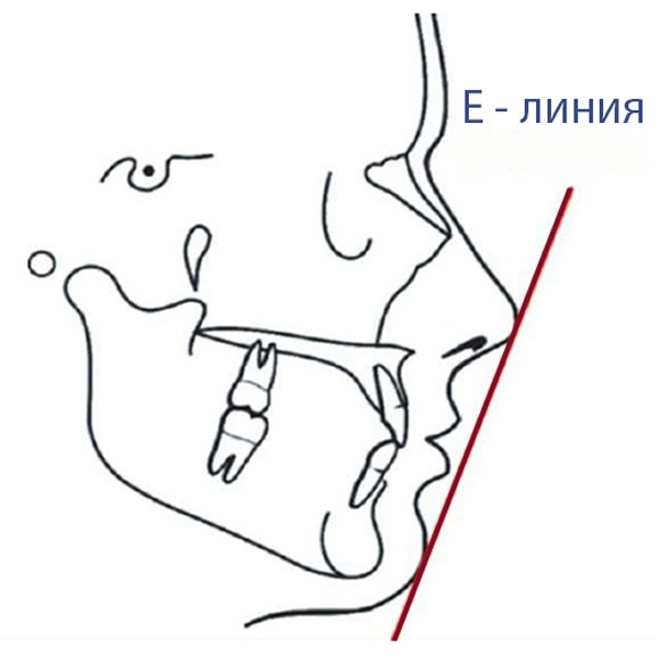 E-line, E-изгиб