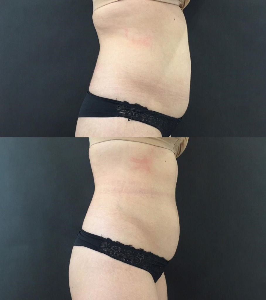 коррекция на аппарате Clatuu, фото до и после