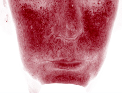 коррекция розацеа препаратом REVI, фото до