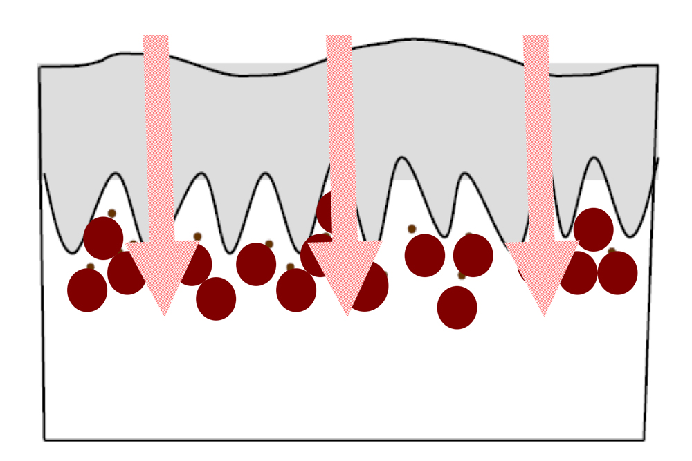 Терапия: селективное поглощение лазерного излучения