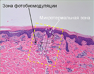 фракционный фототермолиз