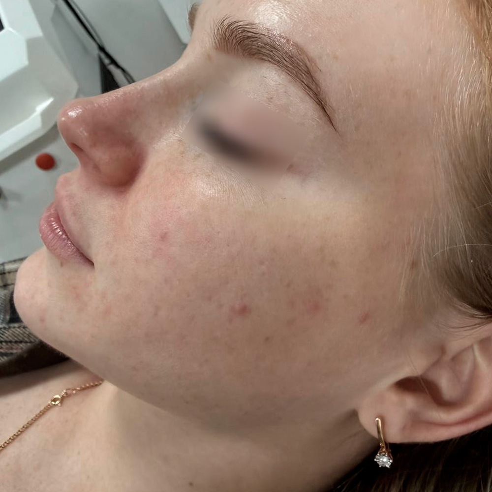 Ixtron Sprint Angel, фото после 1 процедуры