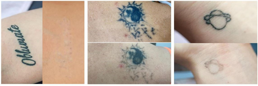 Удаление татуировок PicoCare