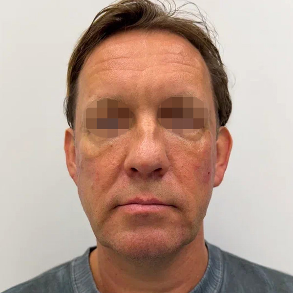 Neauvia Man, фото до и после