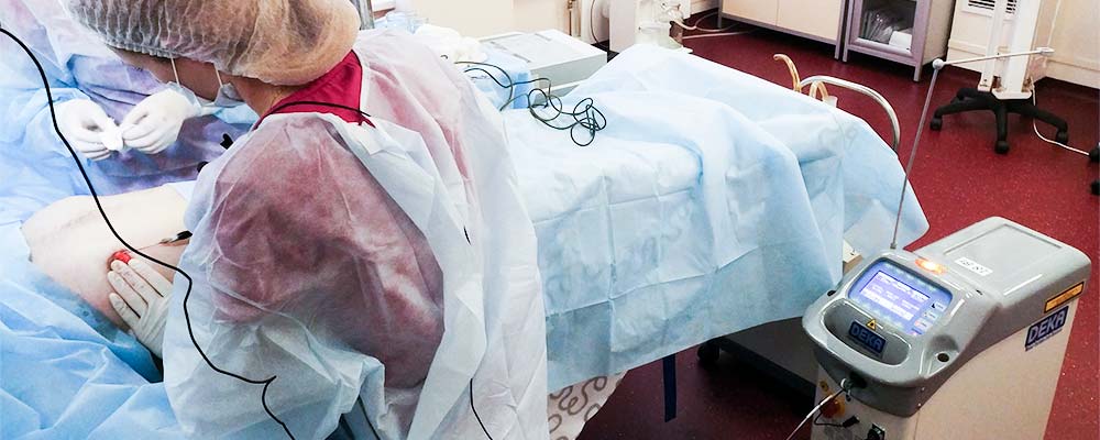 Лечение гинекомастии лазером DEKA SmartLipo lechenie_ginekomastii_lazerom_DEKA-SmartLipo