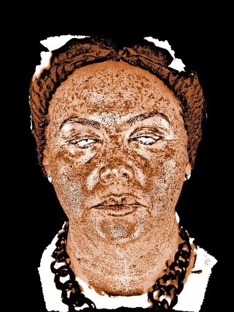 Распределение меланина в коже