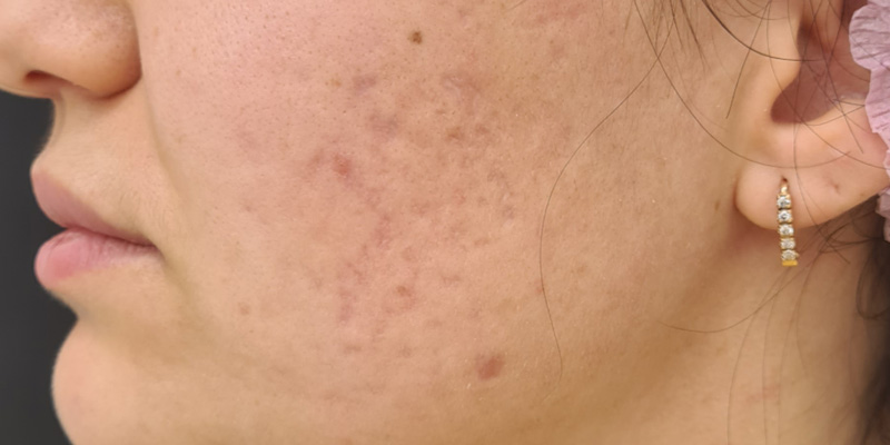 Комбинированная терапия акне