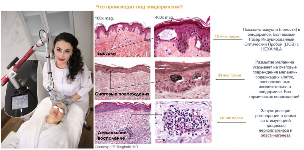 аппарат PicoCare