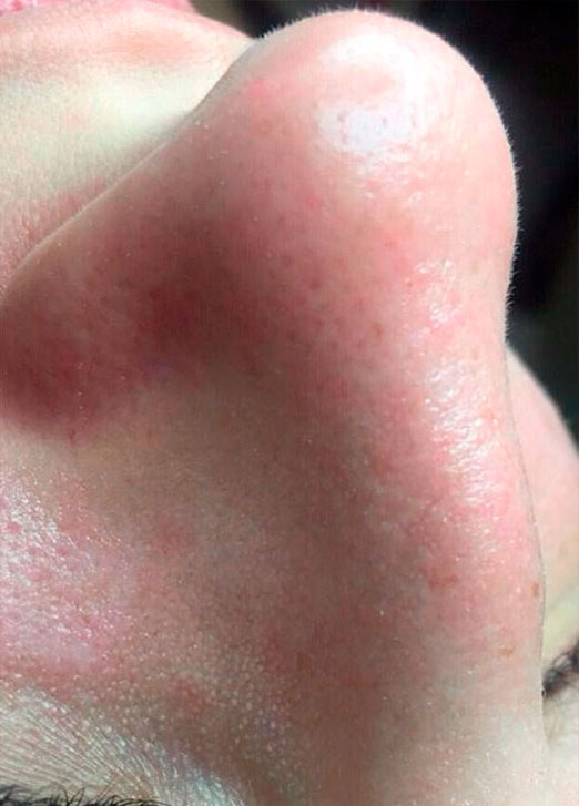 препараты Magiray для коррекции акне