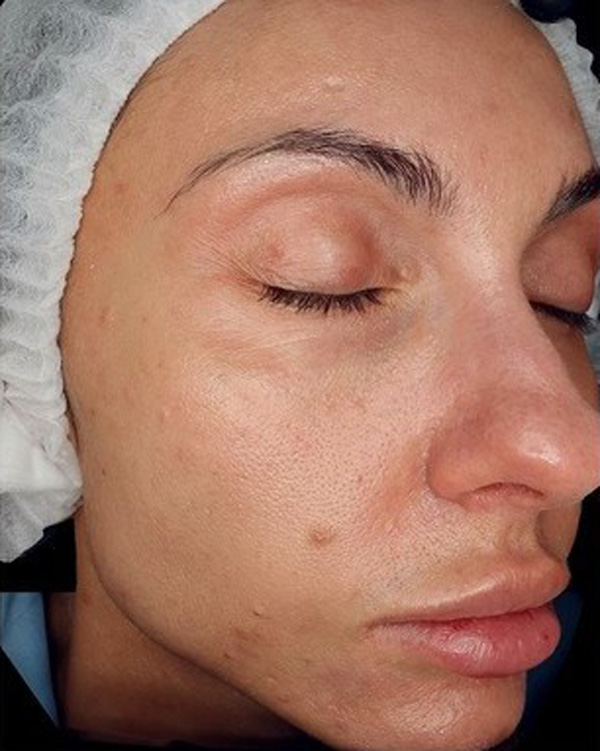 Calecim Professional Serum