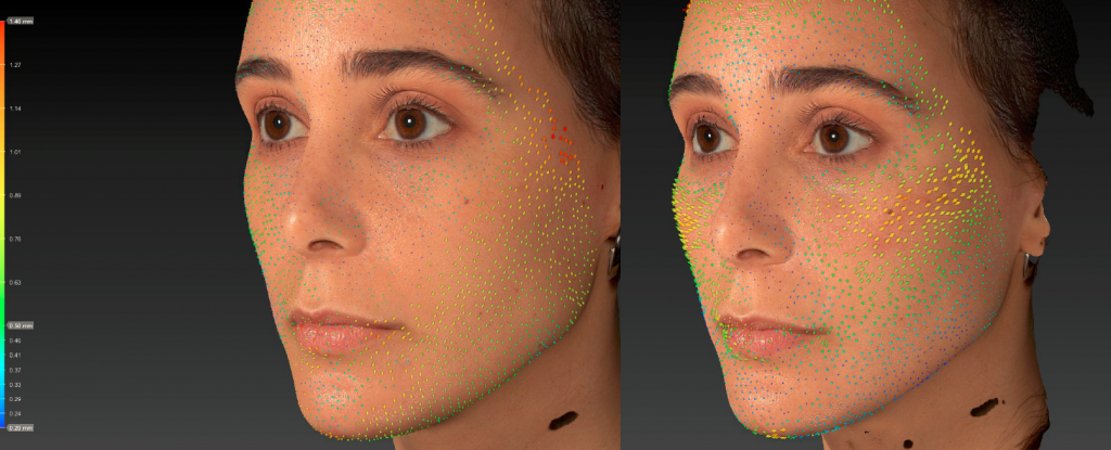 Техника В.UP филлерами Belotero