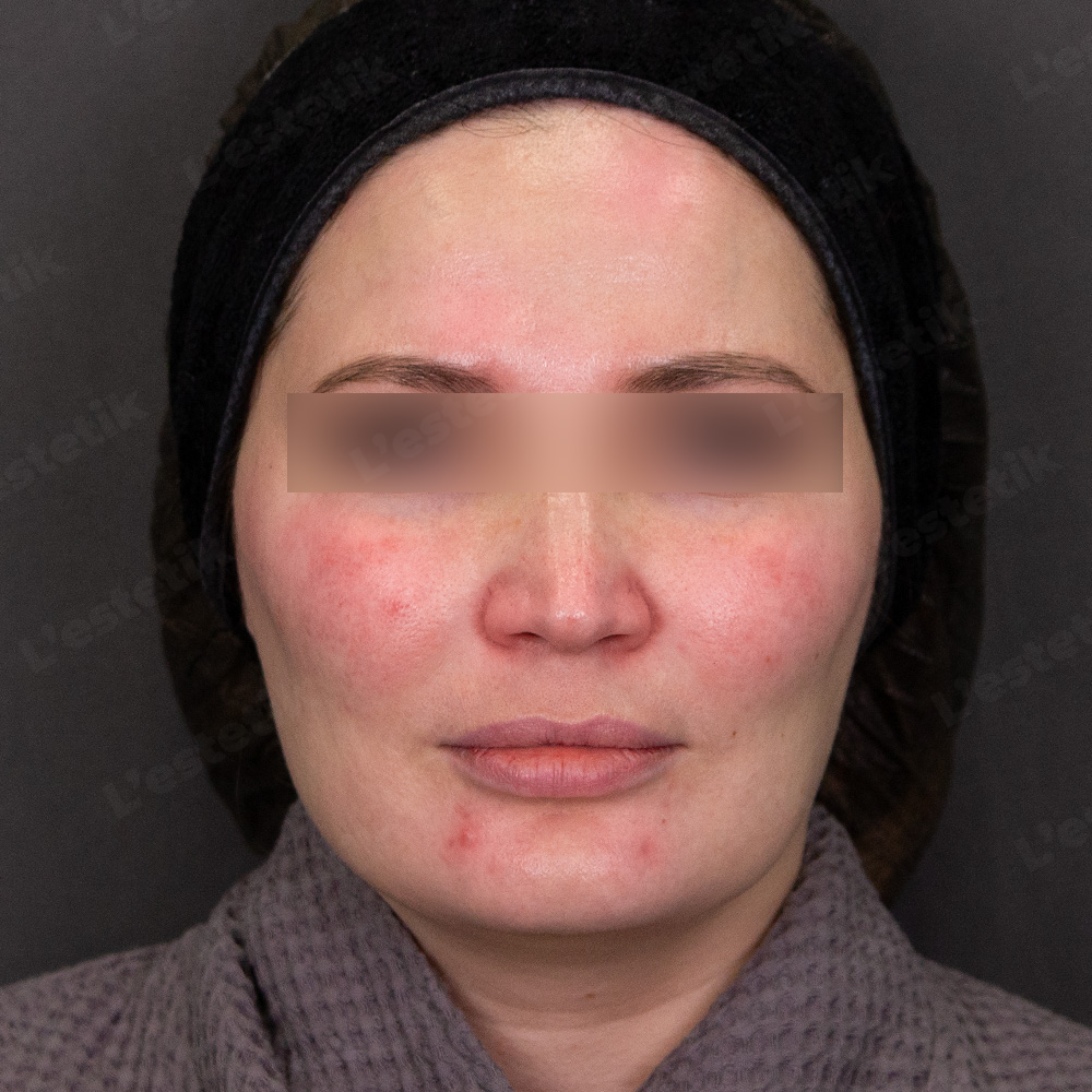 Клинический случай: розацеа