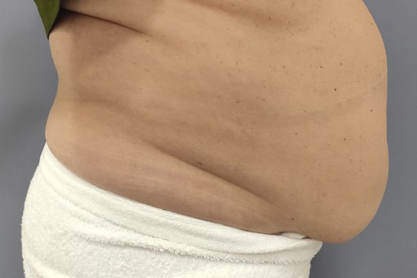 SLIMUS, фото до и после