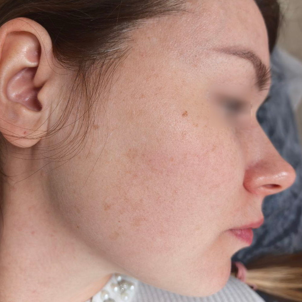 Ixtron Sprint Angel, фото после 1 процедуры