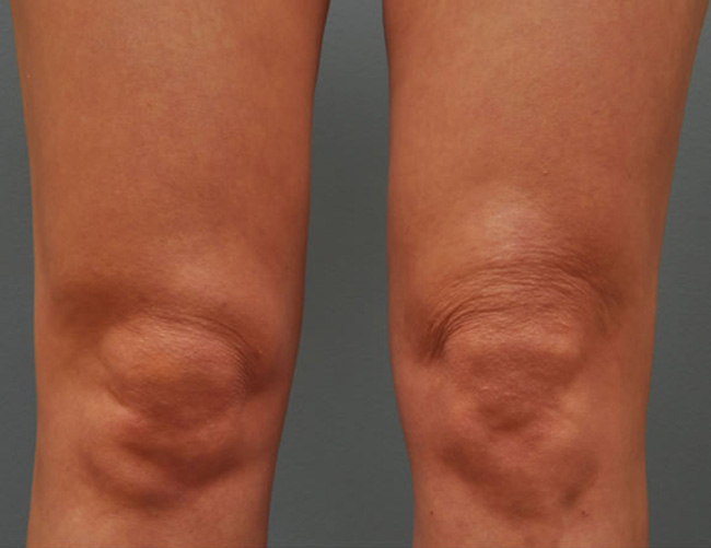 Ultherapy колени, фото после