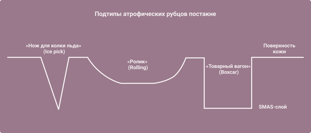 Подтипы атрофических рубцов постакне