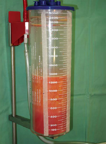 аспират жира