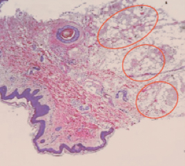 лечение гипергидроза на аппарате MiraDry