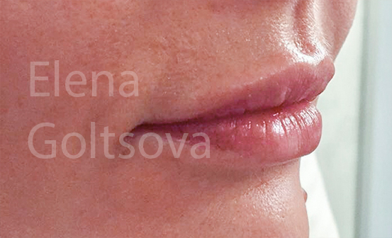 создание объема губ препаратом Belotero Balance, фото после процедуры