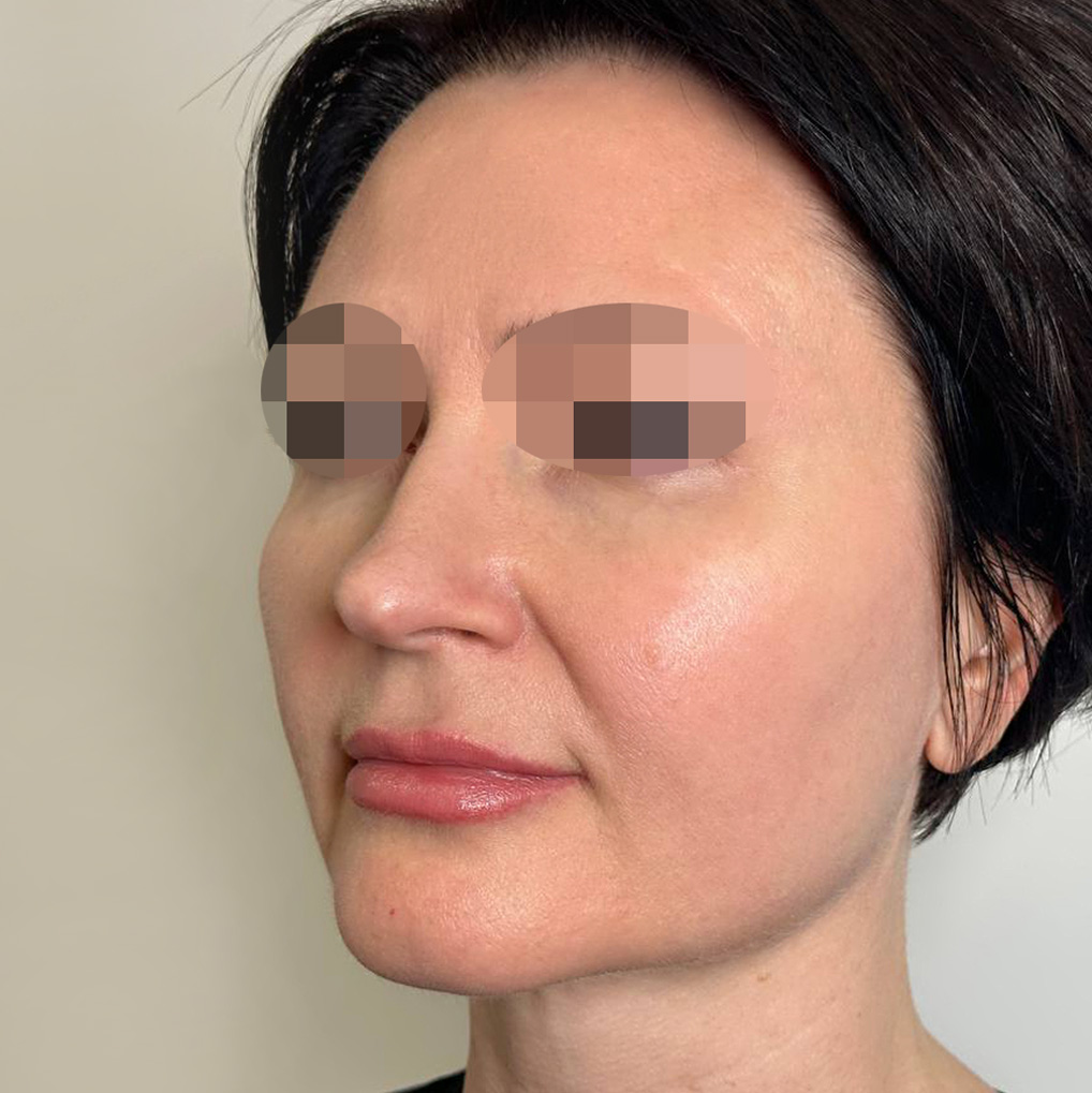 Express-Glow процедура