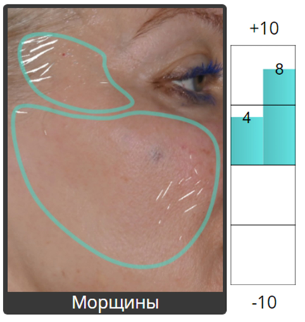 Протокол процедуры Peach Peel PRO и Colibriderm Hydro, фото после