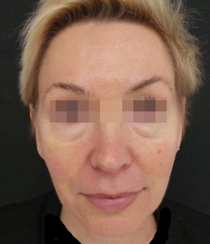 Скульптра (Sculptra) фото после