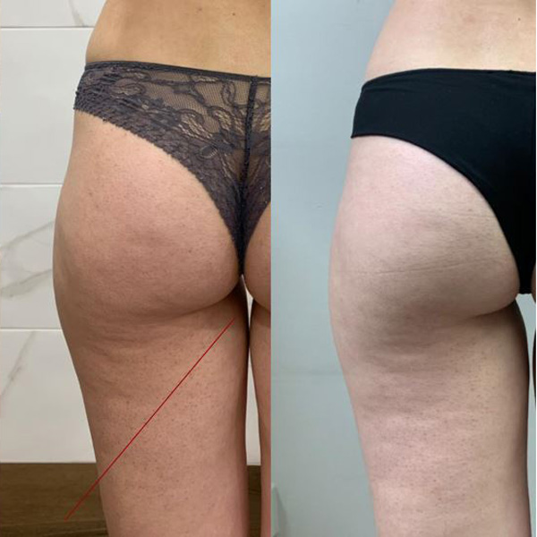 SLIMUS, фото до и после