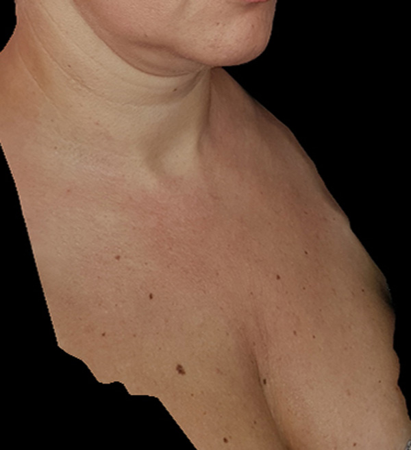 Скульптра (Sculptra) фото до