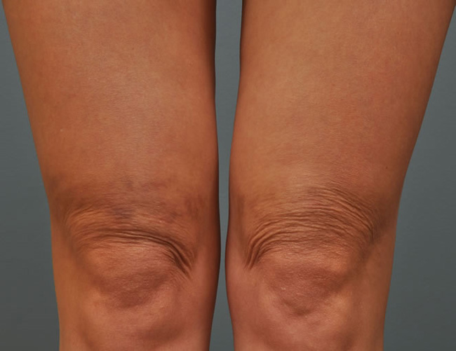 Ultherapy колени, фото до