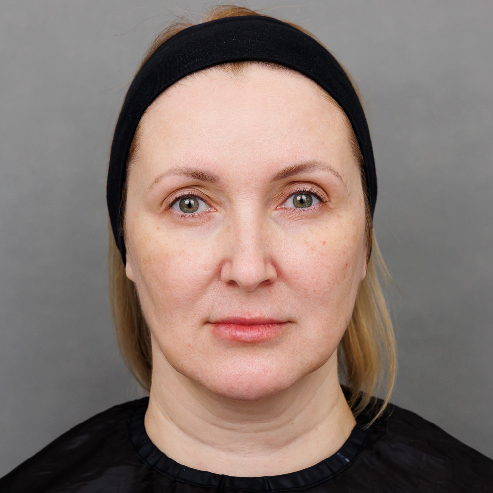 Микроигольчатая RF-терапия Morpheus 8 (InMode): фото до