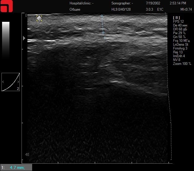 Соединительная ткань при установке каппы и сильном надавливании на манипулу