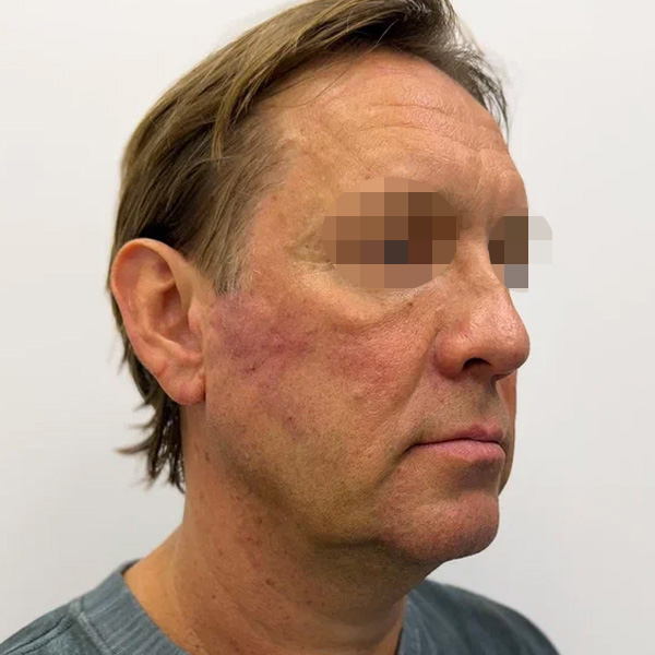 Neauvia Man, фото до и после