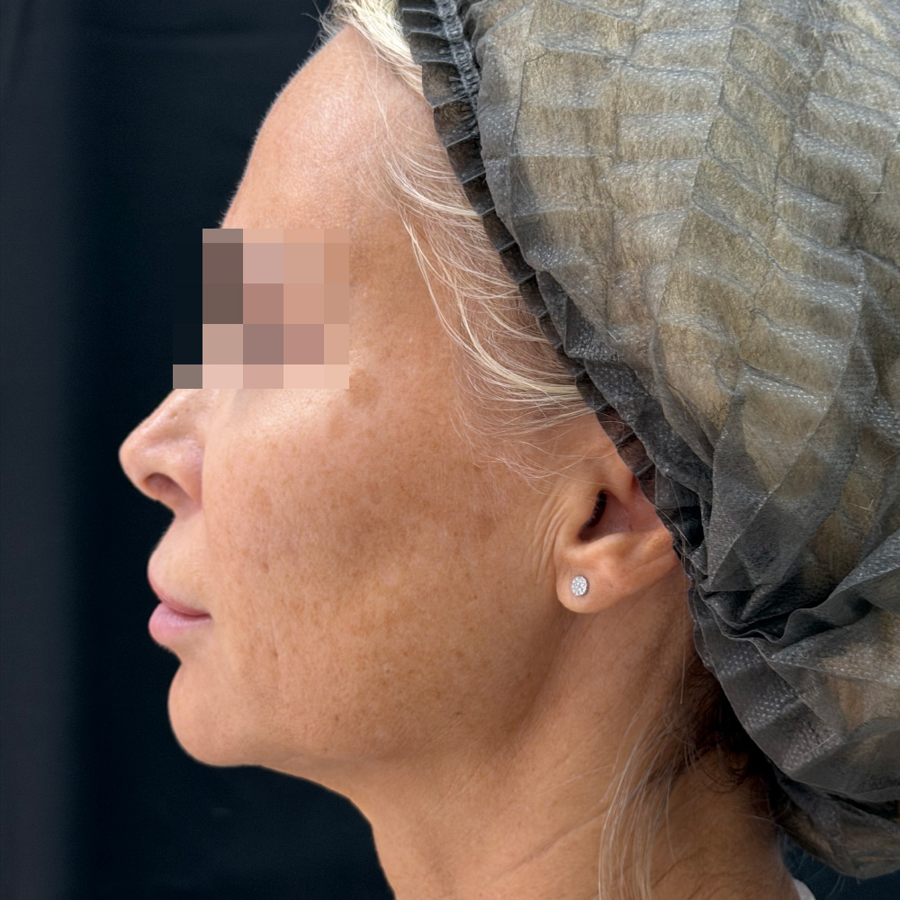 Oligio и Neauvia: фото до