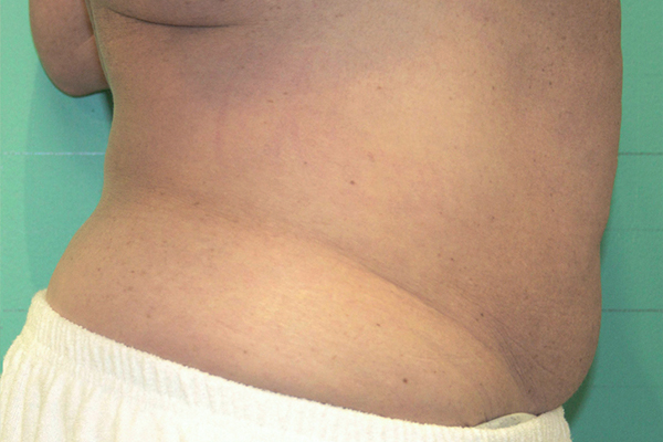 Зона живота после процедуры на аппарате Exilis Ultra 360™