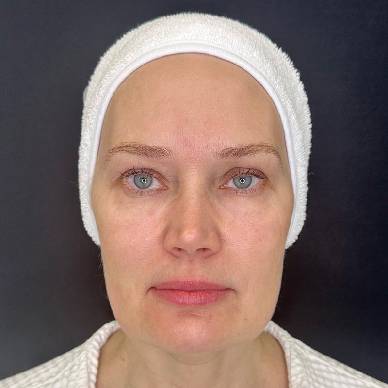 Протокол Bio-Mix Regenyal, фото после