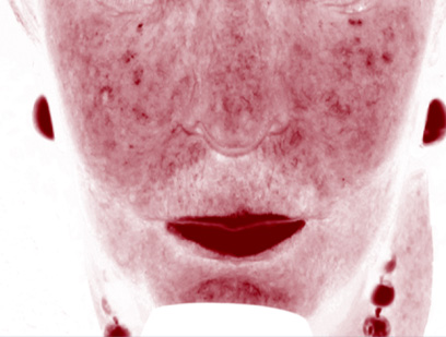 коррекция розацеа препаратом REVI, фото после