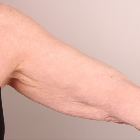 Ultherapy плечи, фото после