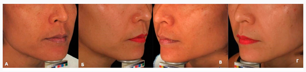 Пикосекундное омоложение PicoCare TONING