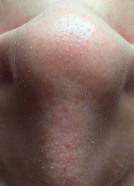 препараты Magiray для коррекции акне