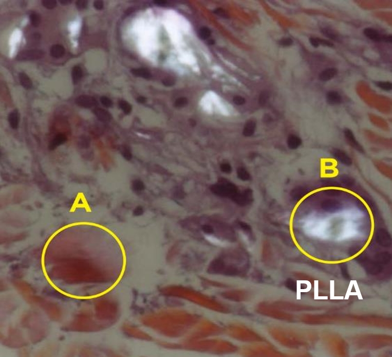 Sculptra деградация частиц PLLA в тканях