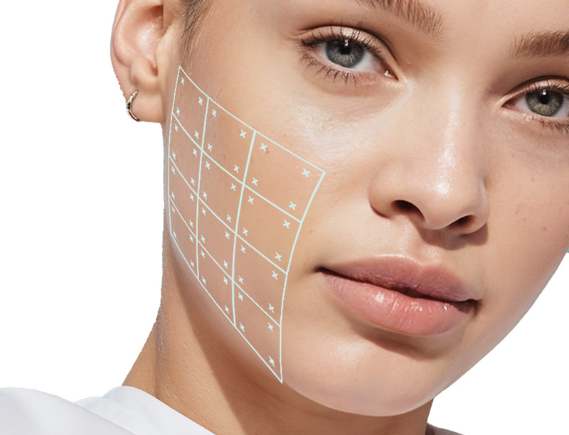 Введение препарата. Процедура AquaGlow с Belotero Введение препарата. Процедура AquaGlow с Belotero