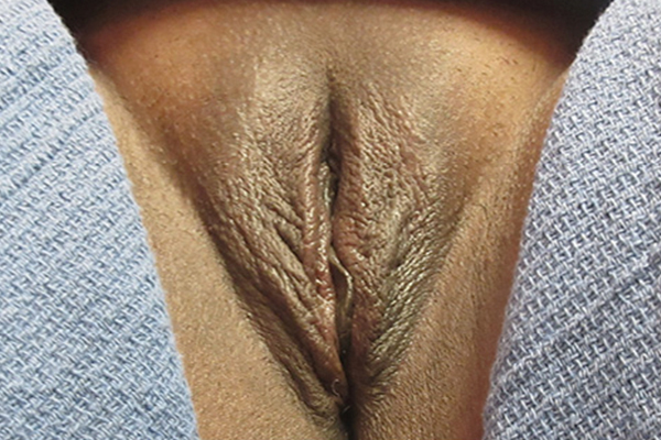 После процедуры на аппарате Exilis Ultra 360™