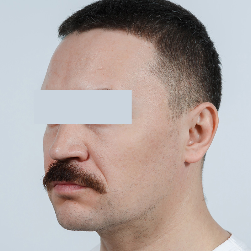 RRS® HA Long Lasting