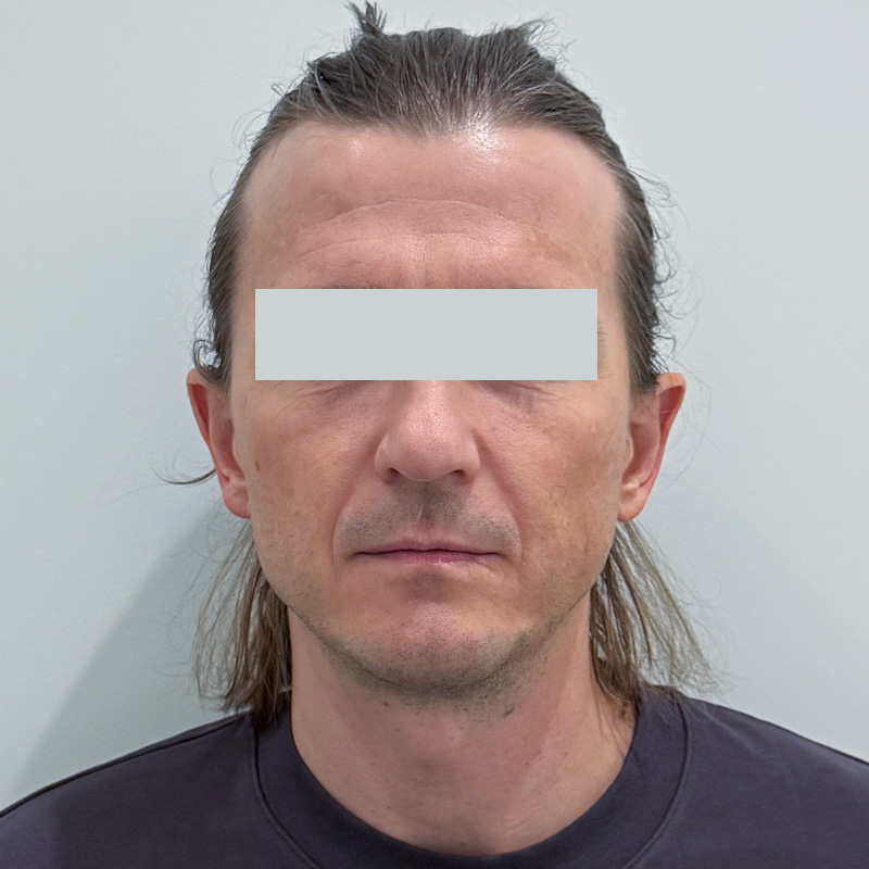 RF и HIFES на аппарате Emface